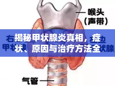 揭秘甲状腺炎真相,症状、原因与治疗方法全解析!